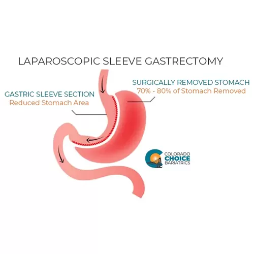 Laparoscopic Sleeve Gastrectomy