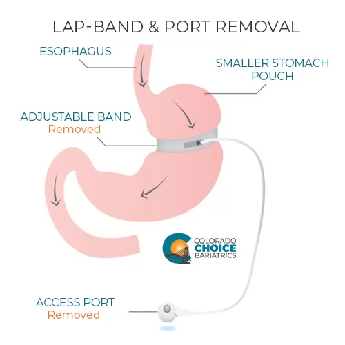 Lap-Band and Port Removal