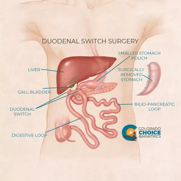 Duodenal Switch Surgery