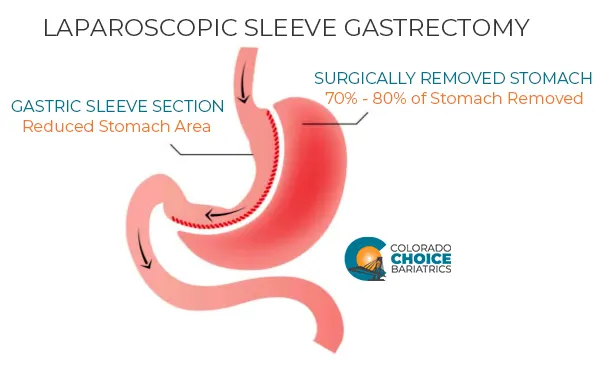 Laparoscopic Sleeve Gastrectomy Diagram